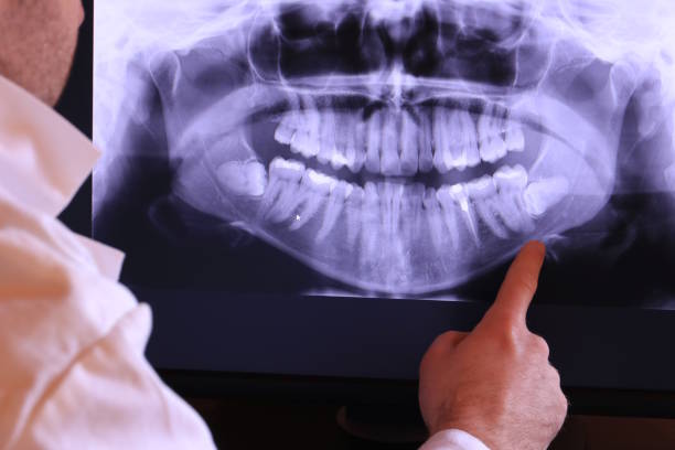 Best Knocked-Out Tooth (Avulsed Tooth) Treatment in Crouch Mesa, NM